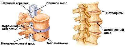 Остеохондроз шейного отдела позвоночника