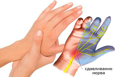 Почему немеет большой палец на руке левой? Возможные причины и методы лечения