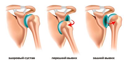Вправление вывихов суставов