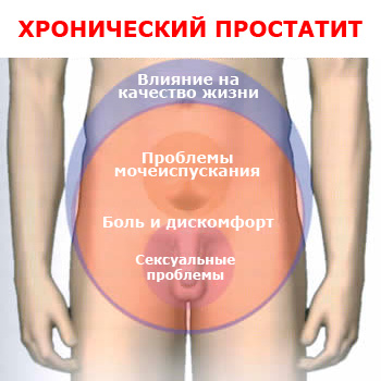 Симптомы простатита
