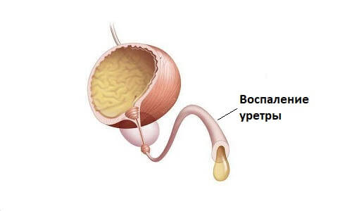 Все об уретрите