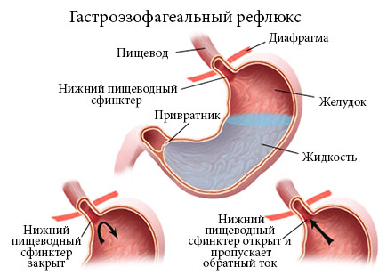 Гастроэзофагеальная рефлюксная болезнь