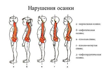 нарушение осанки