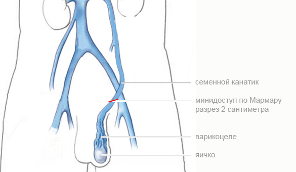 Варикоцеле