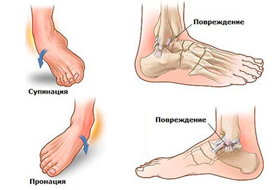 Лечение растяжений